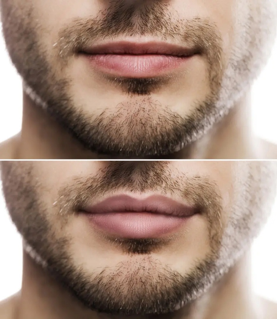 Embracing Confidence: Men And Lip Fillers