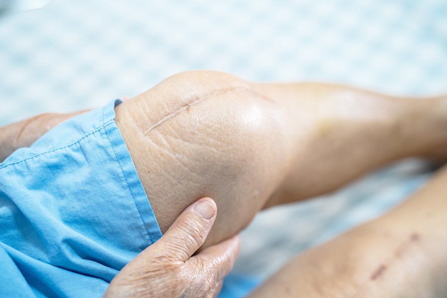 The Cost Of Knee Surgery Differs Based On It Treatment